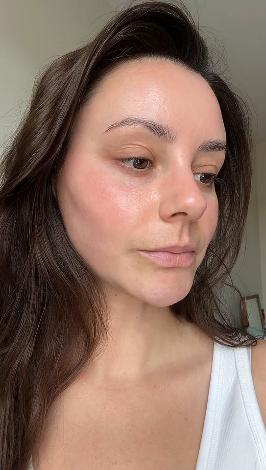 The Beauty Editor's Curse: How Overuse of Skincare Products Can Lead to Perioral Dermatitis