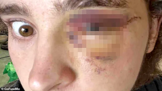 Alleged ICE Projectile Injury Leaves Protester Blind, Sparks Force Debate in Santa Ana