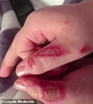 Nine-Year-Old Suffers Severe Burns After Participating in Dangerous TikTok Microwave Trend Involving Sensory Toy