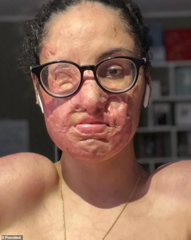 Aspiring Rapper Indicted Five Years After Acid Attack; Song Released