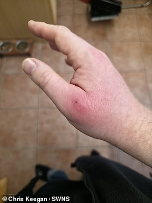 False Widow Spider Bite Leaves Man with Swollen Hand the Size of a Bowling Ball, Hospitalized