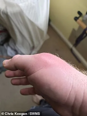 False Widow Spider Bite Leaves Man with Swollen Hand the Size of a Bowling Ball, Hospitalized