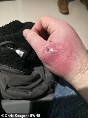 False Widow Spider Bite Leaves Man with Swollen Hand the Size of a Bowling Ball, Hospitalized
