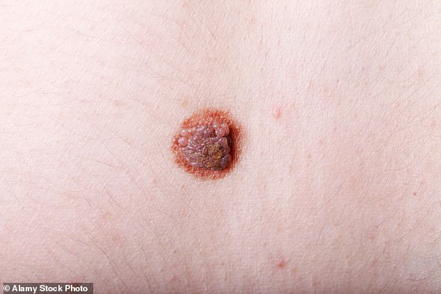 Global skin cancer cases surge toward 2050 as melanoma deaths rise.