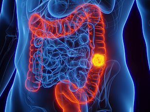 New study links high birth weight to bowel cancer risk in young people.