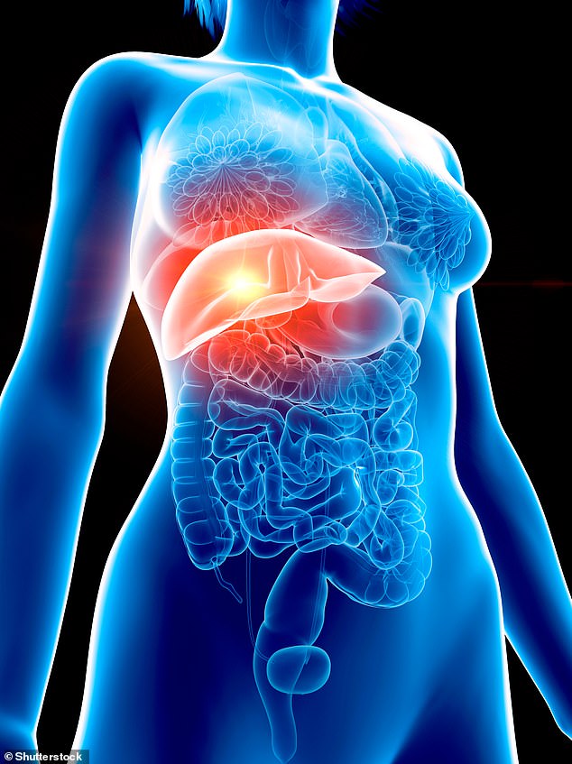 Fatty Liver Disease Drastically Increases Risk of Lethal Bowel Cancer