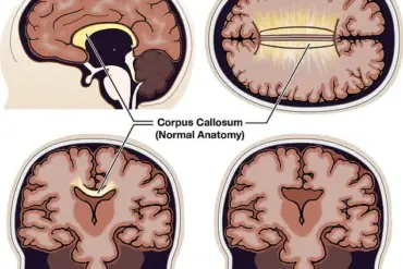 Living with Agenesis of the Corpus Callosum: Real-Life Impacts of a Rare Neurological Disorder