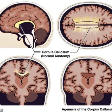 Living with Agenesis of the Corpus Callosum: Real-Life Impacts of a Rare Neurological Disorder