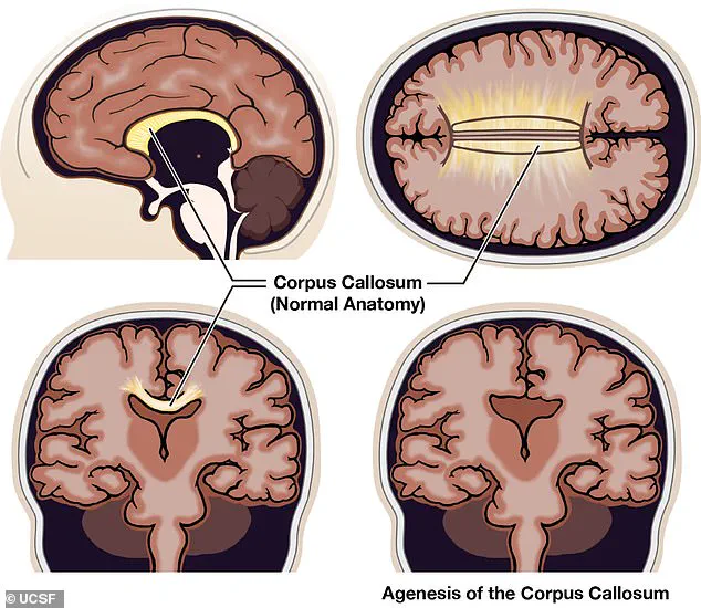 Living with Agenesis of the Corpus Callosum: Real-Life Impacts of a Rare Neurological Disorder