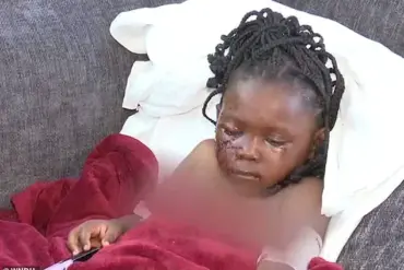 Five-Year-Old Girl in South Bend Mauled by Pit Bulls, Sustains Severe Injuries
